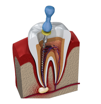 Root canal treatment Peabody MA