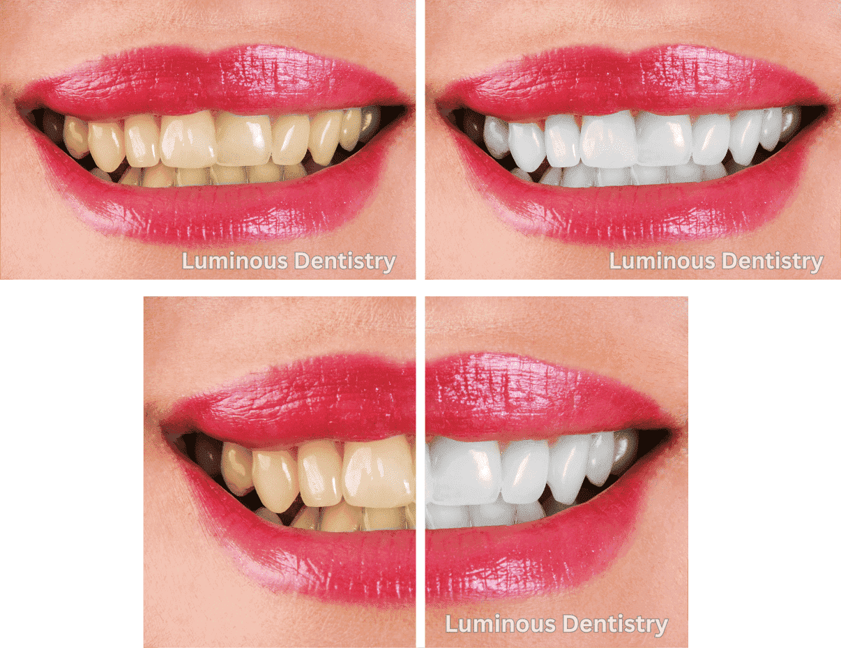 Teeth bleaching Reading | Peabody | Lynnfield MA