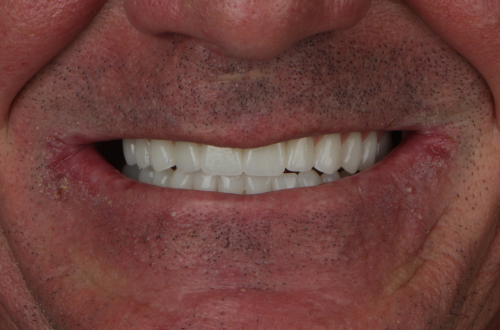 Patient smile after dental implant treatment at Luminous Dentistry