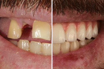 Before and after veneers and crowns — Luminous Dentistry