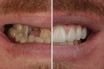 Before and after All-on-X dental implant results — Luminous Dentistry