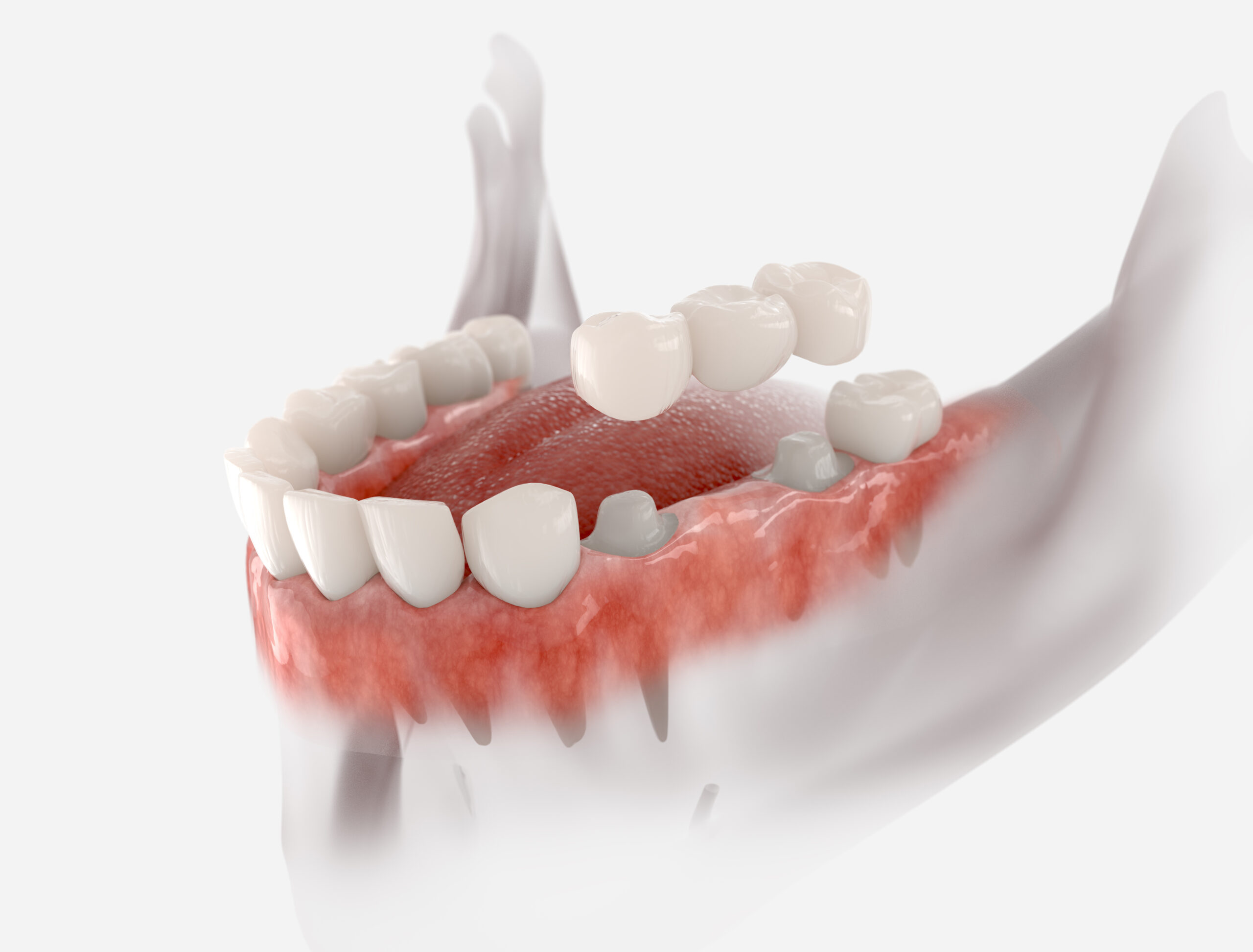Dental restoration patient at Luminous Dentistry Wakefield MA