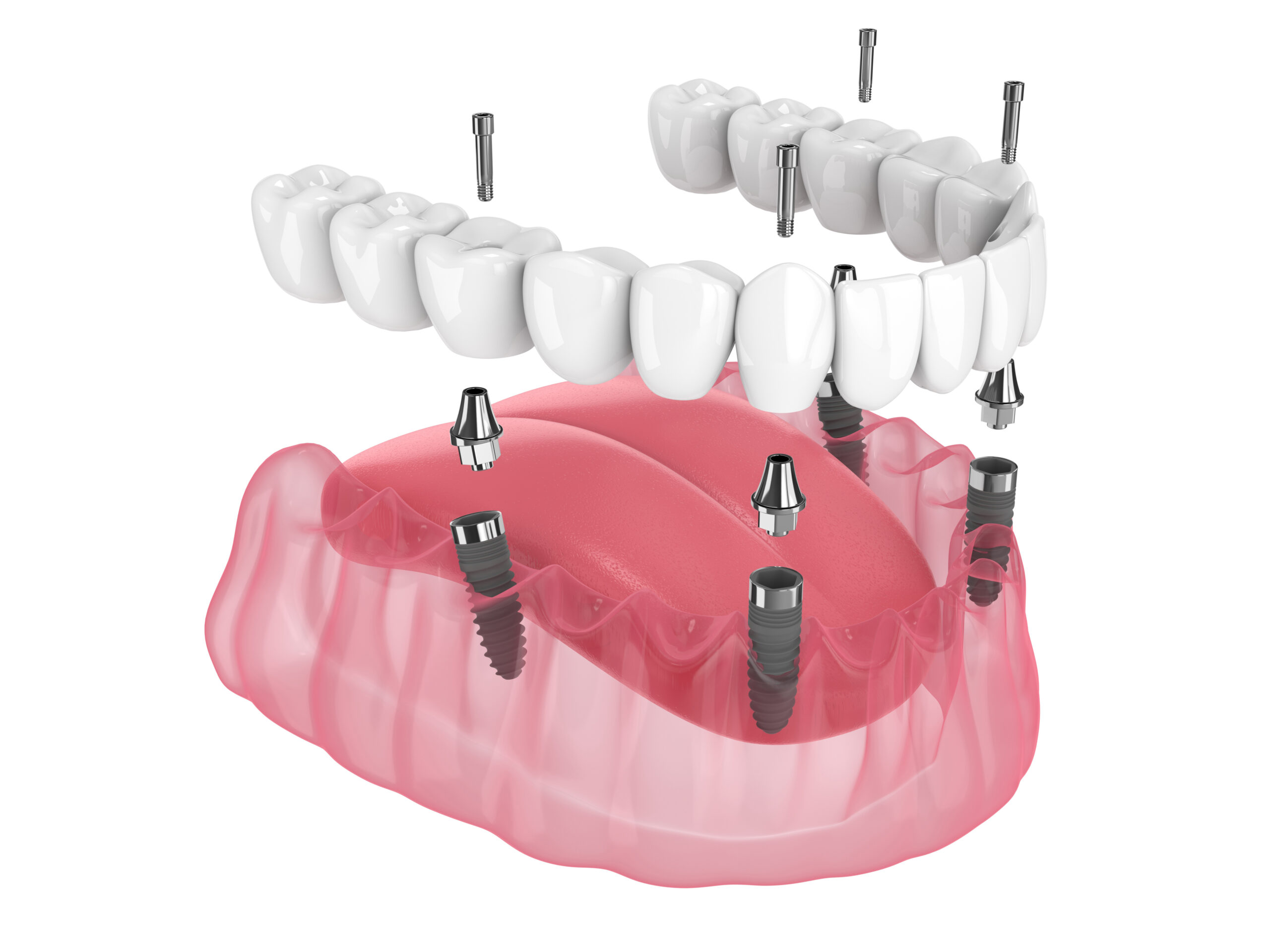 All-on-4 dental implant bridge supported by implants