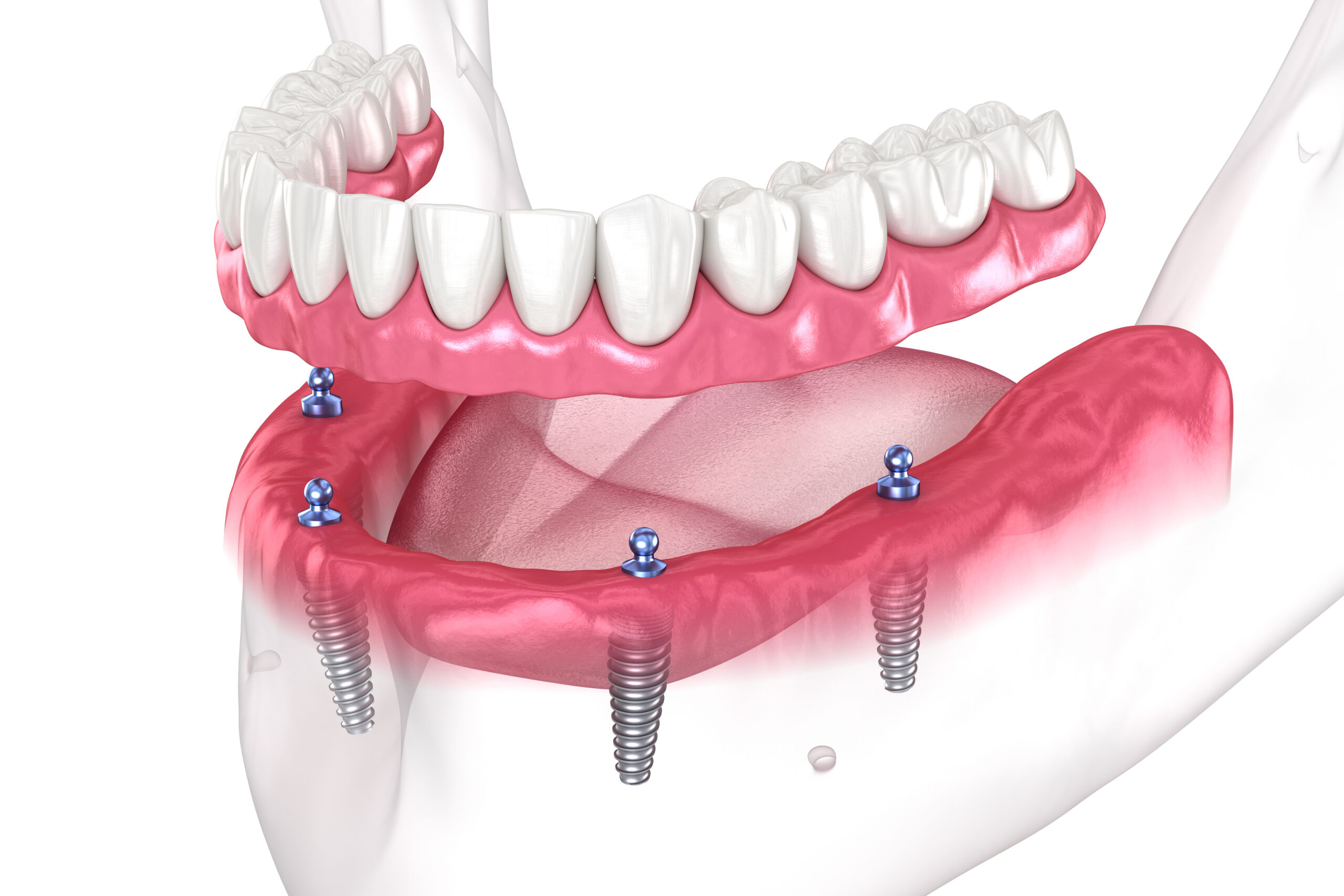 All-on-4 dental implant full arch restoration