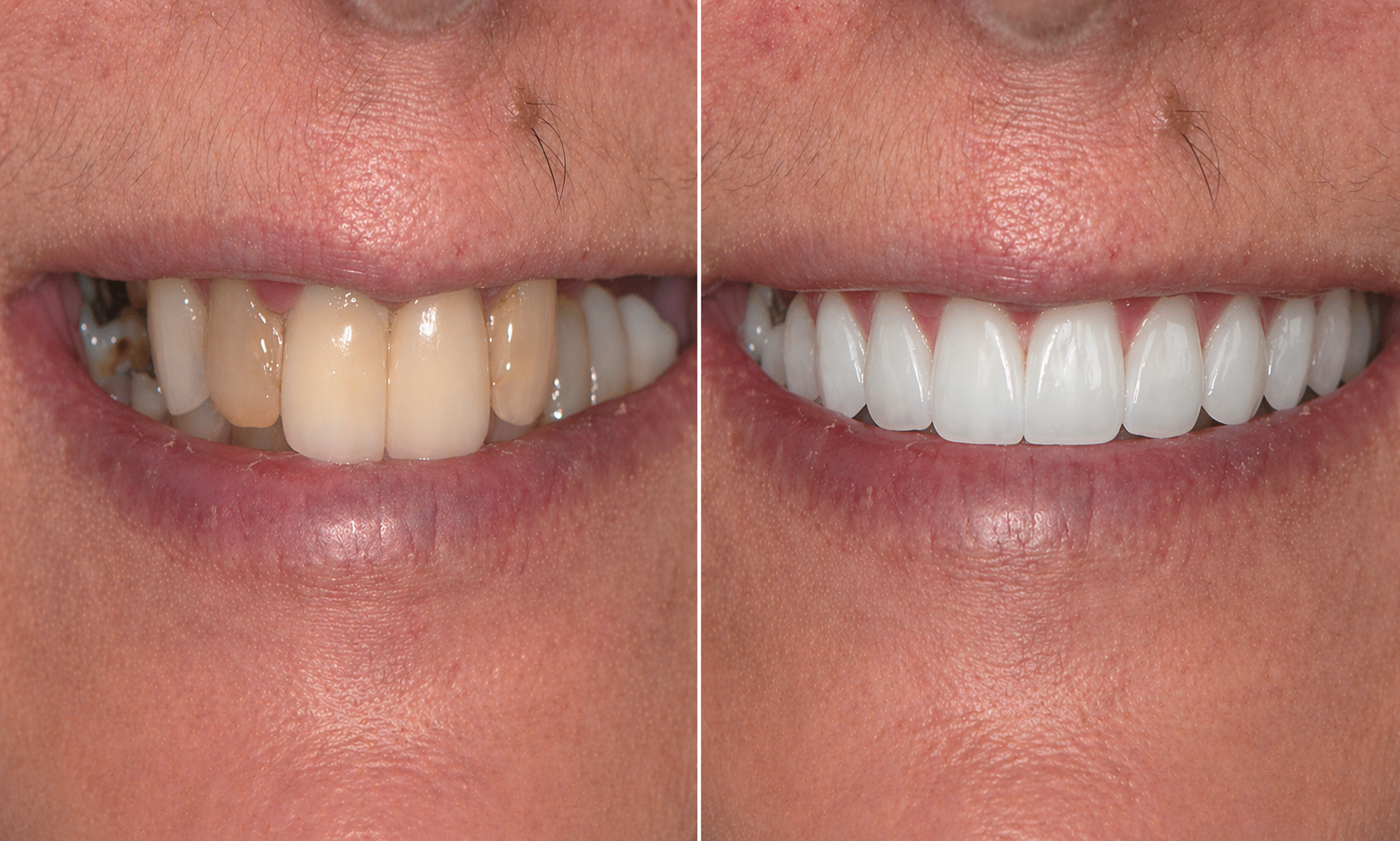 Dental veneers before and after at Luminous Dentistry Wakefield MA